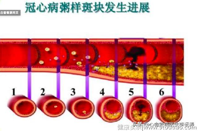 冠心病，吃什么药好呢？