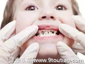 孩子牙齿上黑乎乎的东西是什么?