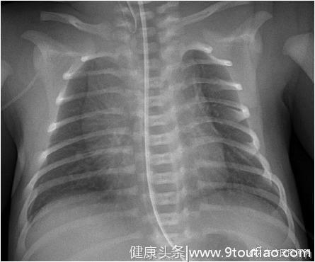 支气管哮喘的检查