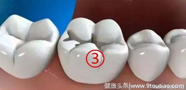 牙齿有洞怎么办？