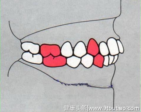 正常的牙齿排列是这个样子，看看你的是否正常？