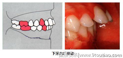 正常的牙齿排列是这个样子，看看你的是否正常？