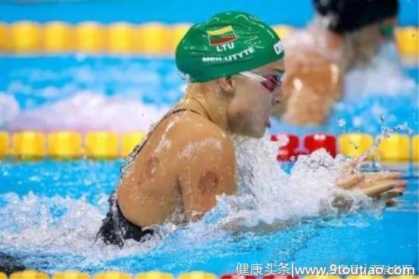 2018亚运会游泳选手热衷于拔罐！中医的秘方就是很有用！