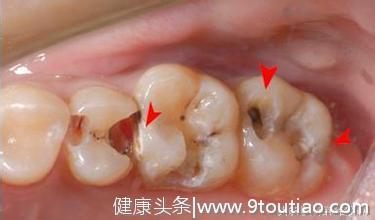 为什么牙齿上会有洞？牙齿长洞应该怎么办？