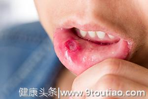 口腔溃疡需警惕 不同成因应对方法各不同