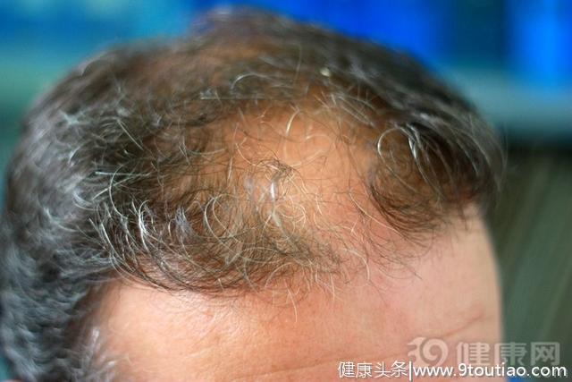 90后脱发，80后秃顶，中国男人还剩多少头发？