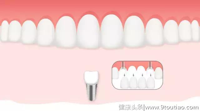 你的牙齿变长牙缝变宽吗？注意！是你的牙龈正在萎缩