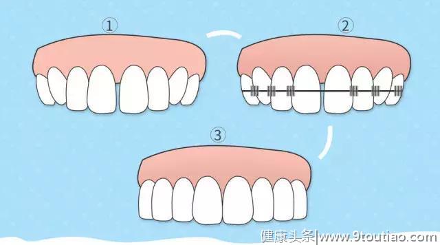 你的牙齿变长牙缝变宽吗？注意！是你的牙龈正在萎缩