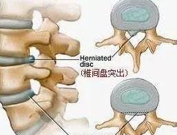 别走冤枉路，找对这2个办法，把“坐”出来的腰间盘回归原位