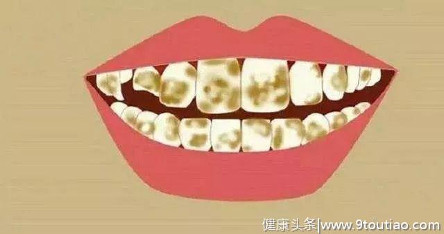 牙齿为什么会变黄？常用的美白方式了解一下