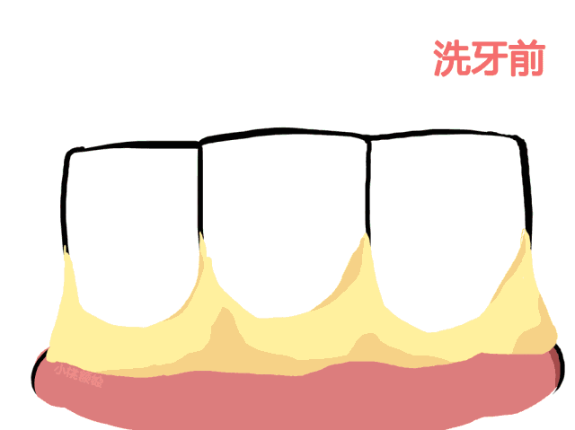 牙齿为什么会变黄？常用的美白方式了解一下
