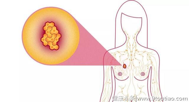 肠道菌群是乳腺癌转移扩散的重要参与者