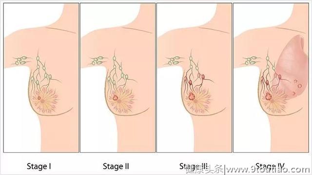 肠道菌群是乳腺癌转移扩散的重要参与者