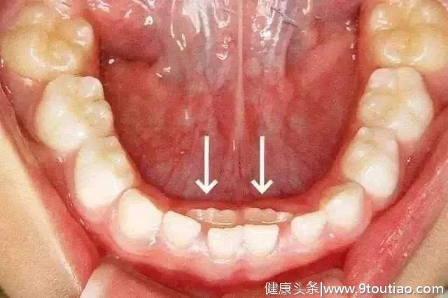 5岁孩子14颗牙齿全烂掉，父母你的常识在哪里？