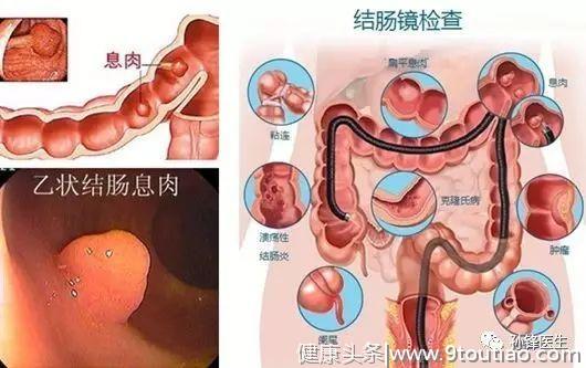 医学科普︱医生，我为什么会得肠癌？