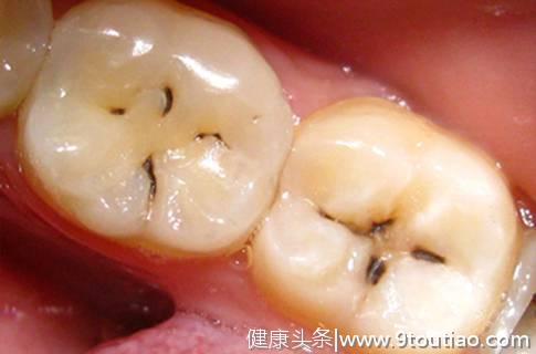 为什么牙齿上会有黑线？牙医揭秘！