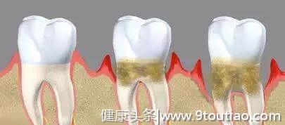你的牙齿有这个症状吗？小心牙周炎已经找上你