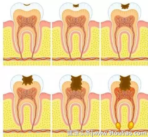 你的牙齿上有黑线吗？牙齿上有黑线，一定就是蛀牙吗？