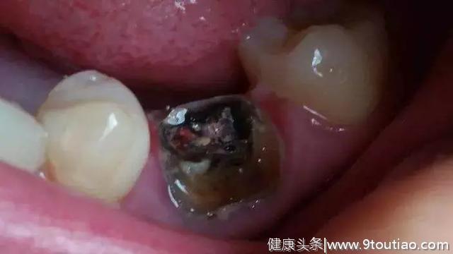 【提醒】深圳阿姨患上口腔癌，竟因一颗烂牙…口腔出现这些迹象要注意！