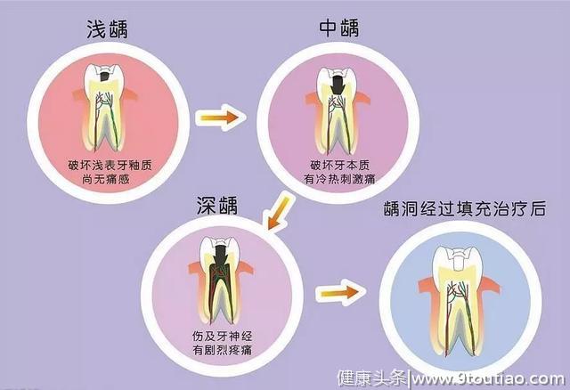 牙疼，孩子蛀牙太苦恼，做好这4步，从根源杜绝蛀牙风险