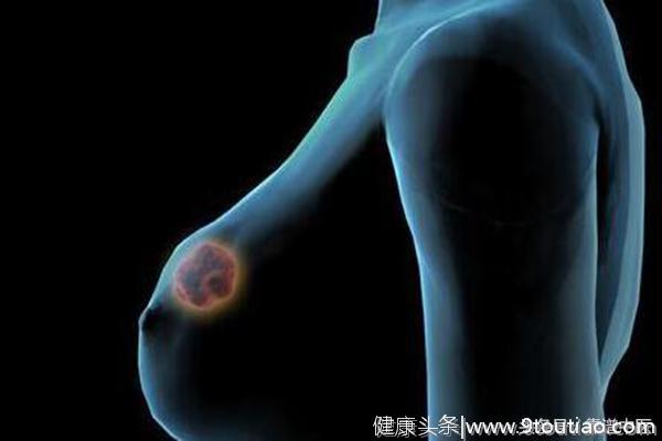 乳腺癌是怎么引起的？它有哪些早期症状呢？
