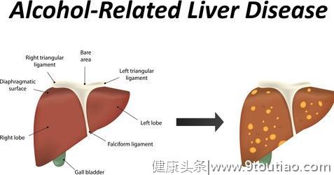 肝硬化可能是吃出来的吗？预防肝硬化，可以多吃什么食物保护肝脏