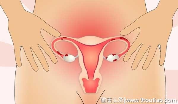 子宫肌瘤别轻易“一刀切”，7个中医秘方或能解忧！