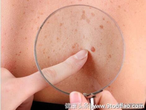 皮肤癌也有预兆，皮肤出现这4个变化，十有八九是皮肤癌，别忽视