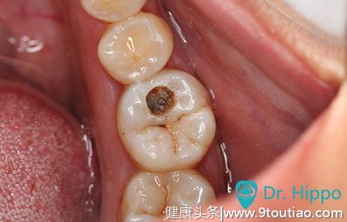 河马医生：孩子容易患上这5种口腔疾病排名！第一居然不是蛀齿
