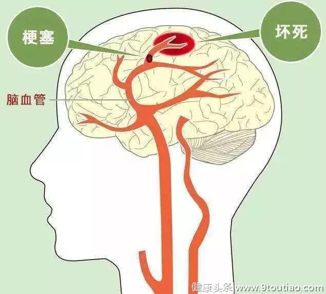 心梗、脑梗、脑出血的求救信号和急救方法