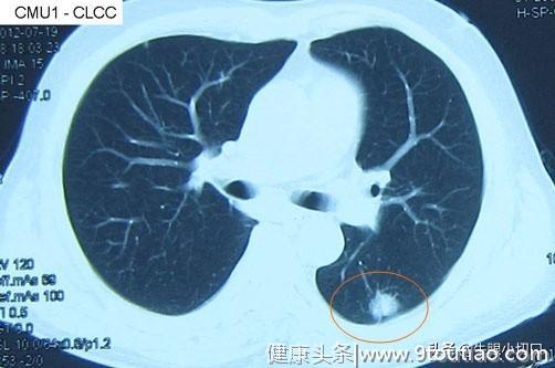什么是肺癌?