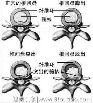 如何区分腰间盘突出、膨出？怎么保护腰椎？关于腰突的四个问题