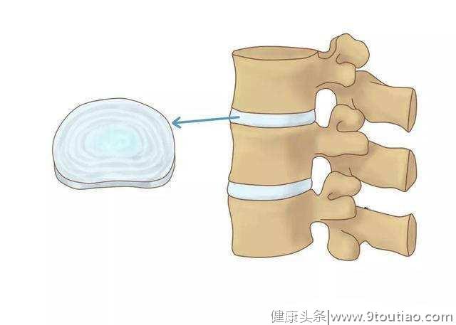 如何区分腰间盘突出、膨出？怎么保护腰椎？关于腰突的四个问题