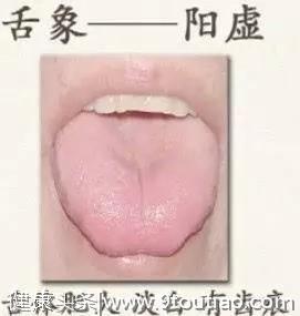 舌头是人体健康的“放大镜”，几种常见舌象的解决办法