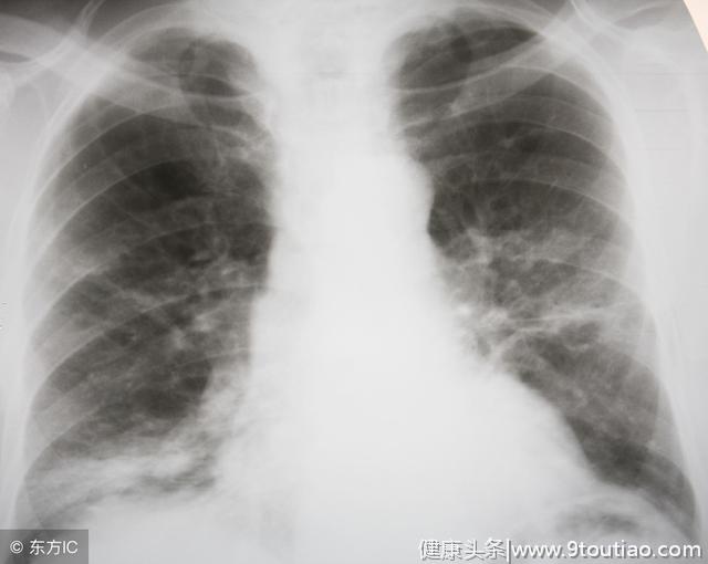 肺炎是怎样形成的？得了肺炎该怎么做？