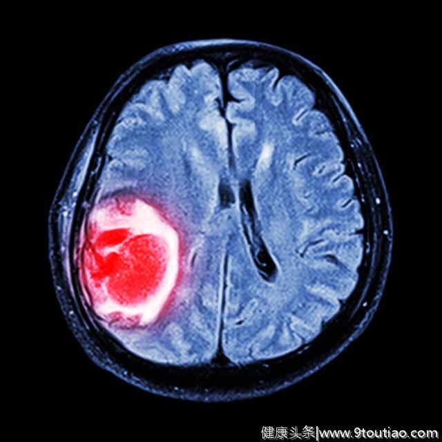 癌症发生脑转移会有什么症状表现？医生的答案来了