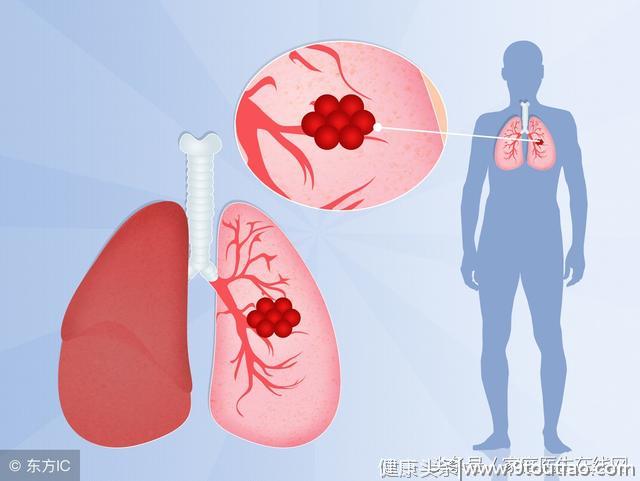 肺癌分为这6个类型，其中这一种肺癌，与抽烟离不开