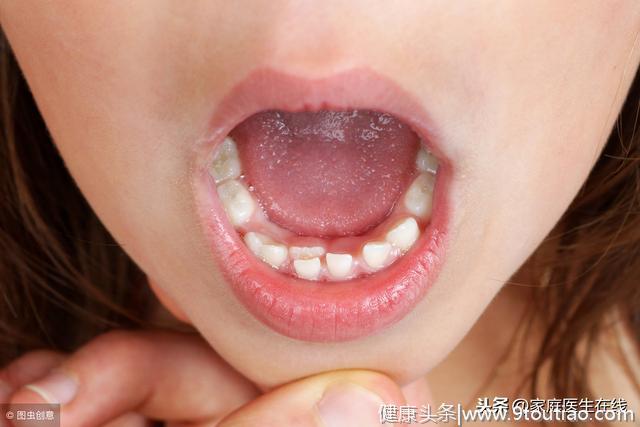 如何让孩子远离龋齿？日常3个预防措施应做好