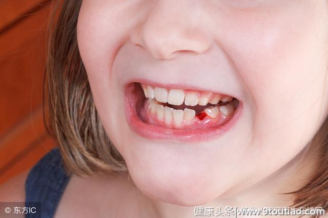 5岁女童严重蛀牙只剩牙根？宝宝的牙齿护理注意这3点