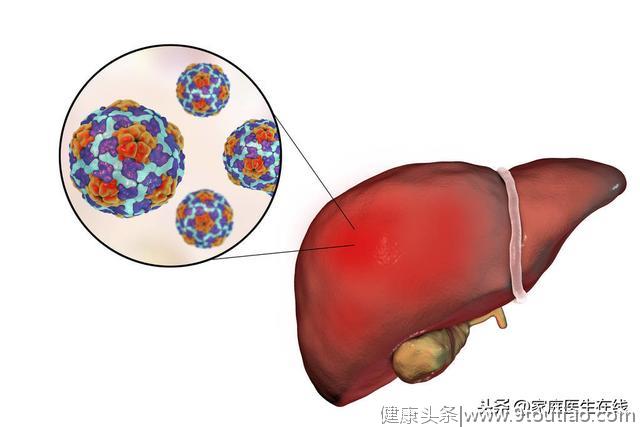 肝硬化不会悄然而至，身体3个异常“迹象”，提示要尽快就医