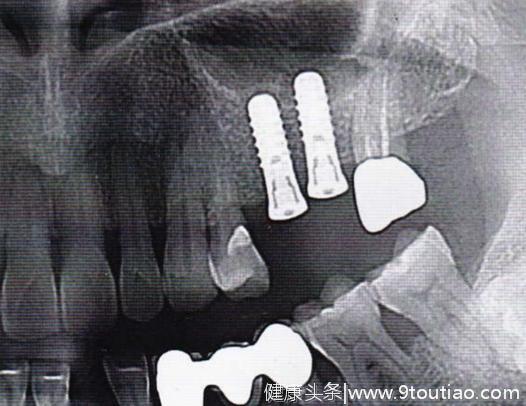 传统齿科种植弊端多，数字化齿科大放光彩