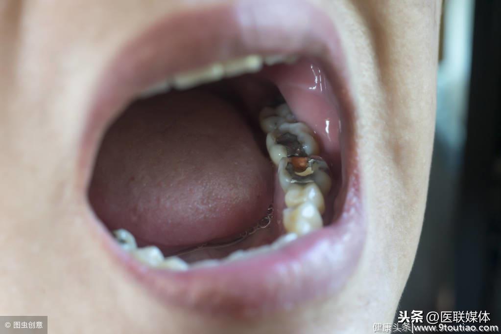 牙齿有小黑点，提醒你要失去这颗牙了？明白龋齿的3个阶段