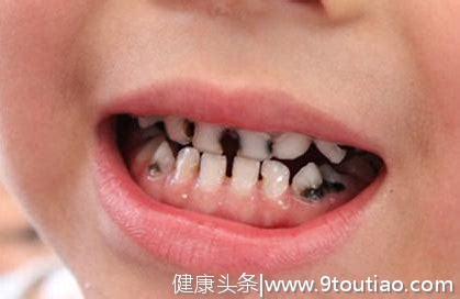 儿童龋齿如何治疗？预防龋齿日常清洁是关键