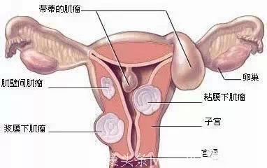 女人妇科炎症到癌症的演变过程