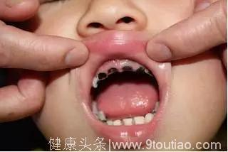儿童蛀牙的危害到底有多大？