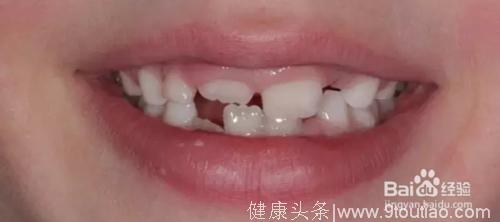 为什么儿童牙齿不齐，牙齿不齐会有什么危害？