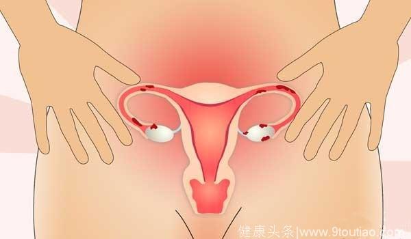 子宫肌瘤别轻易“一刀切”，7个中医秘方或能解忧！