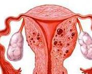 子宫肌瘤能引起月经紊乱吗