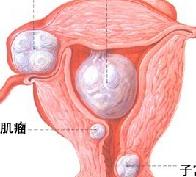 什么情况下子宫肌瘤需要手术