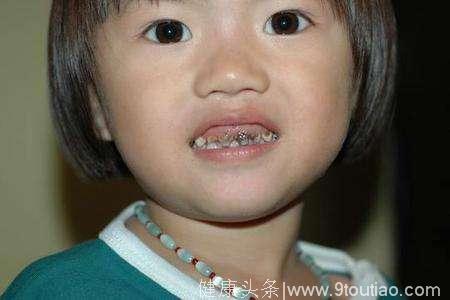 儿童常见的牙齿疾病有哪些？